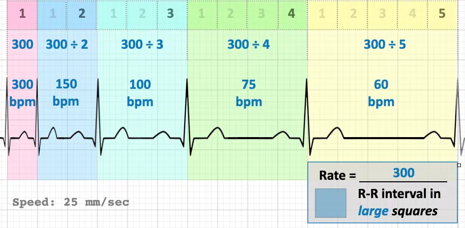 Use this boxed diagram to practice determining rate through R-R intervals.
